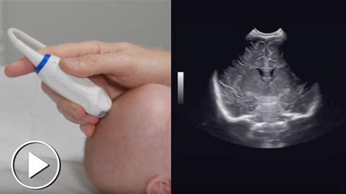 Neonatal ultrasound parameters
